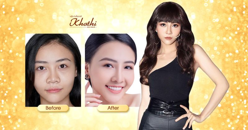 Sửa mũi hỏng